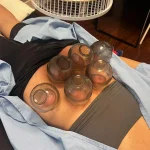 Is there any danger in frequent cupping therapy?