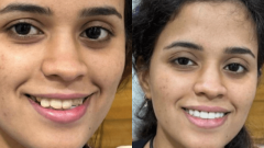 Cosmetic Dentistry In Andheri